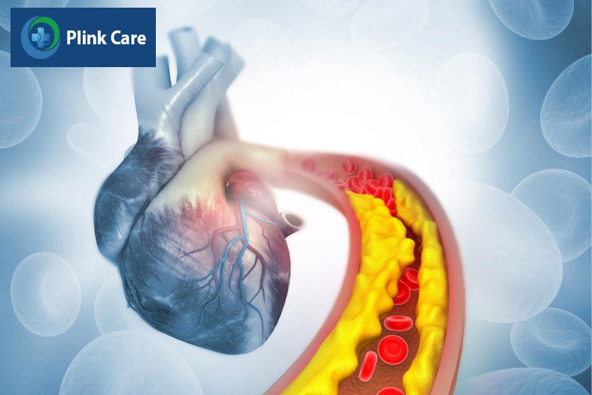 Mảng bám làm hẹp động mạch vành, nguy cơ dẫn đến block nhĩ thất