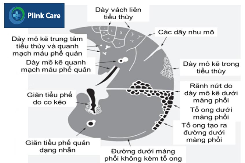 Mô hình các tổn thương xơ hóa trên phim chụp ct