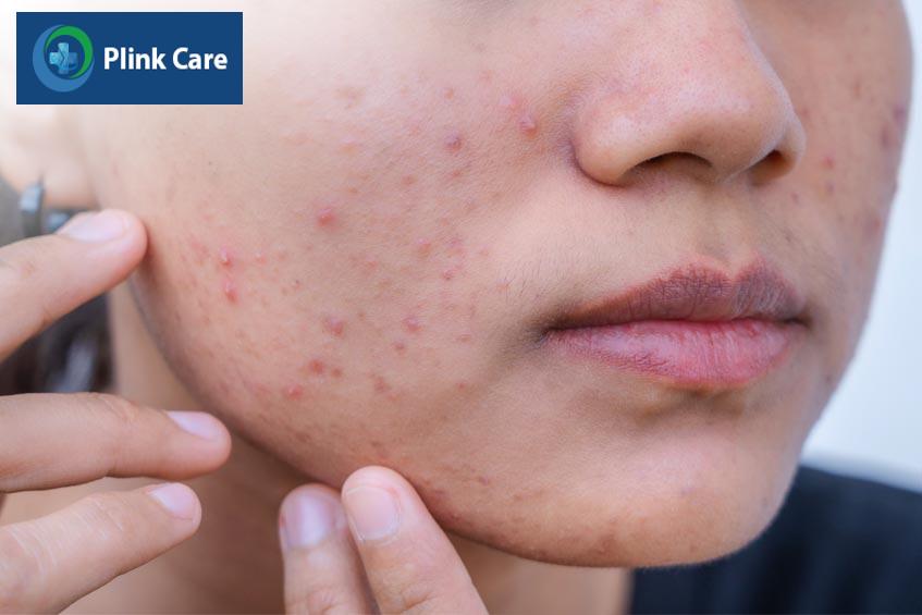 mụn trứng cá là dấu hiệu tăng prolactin máu