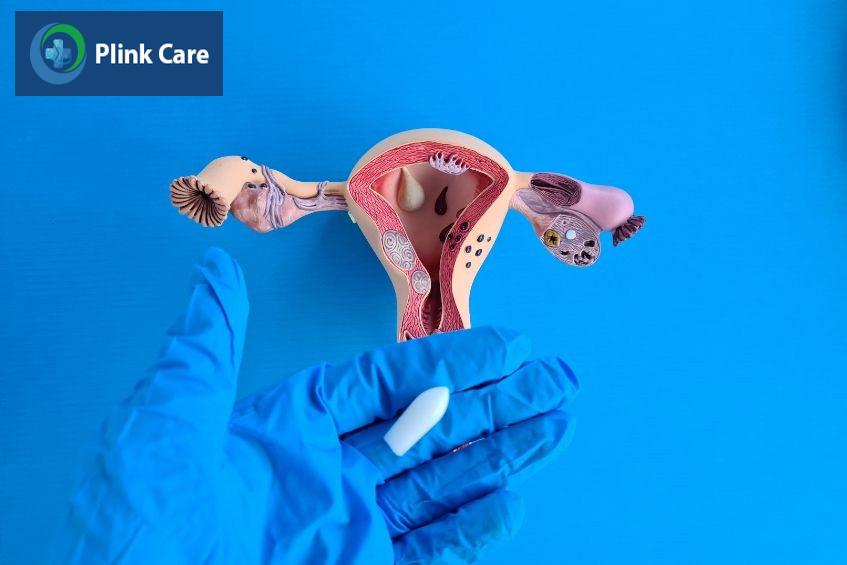 Nên thực hiện đặt thuốc sau chuyển phôi đúng cách theo hướng dẫn từ bác sĩ