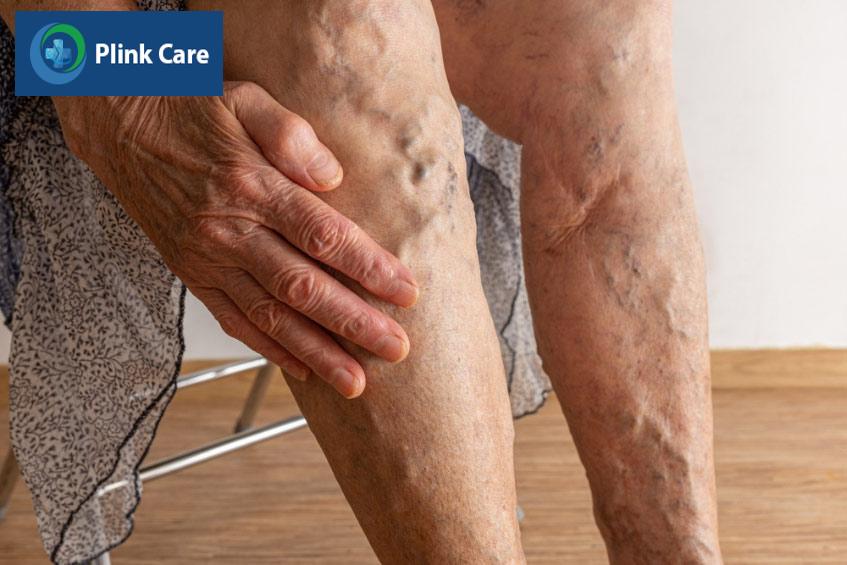 Người bệnh bị sưng phù, cảm giác nặng nề ở chân hoặc mắt cá chân
