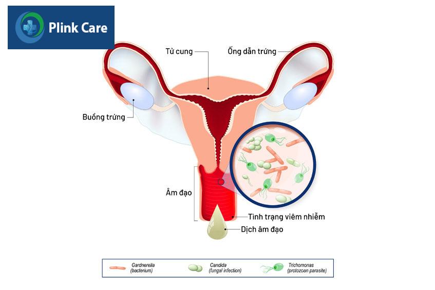 nhiều tác nhân gây bệnh viêm âm đạo