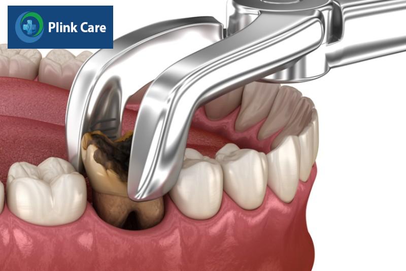 Khi nào phải nhổ răng vĩnh viễn?