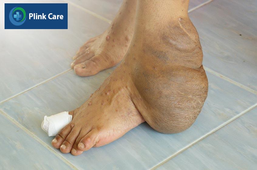 phẫu thuật u xơ thần kinh là phương pháp điều trị phổ biến hiện nay