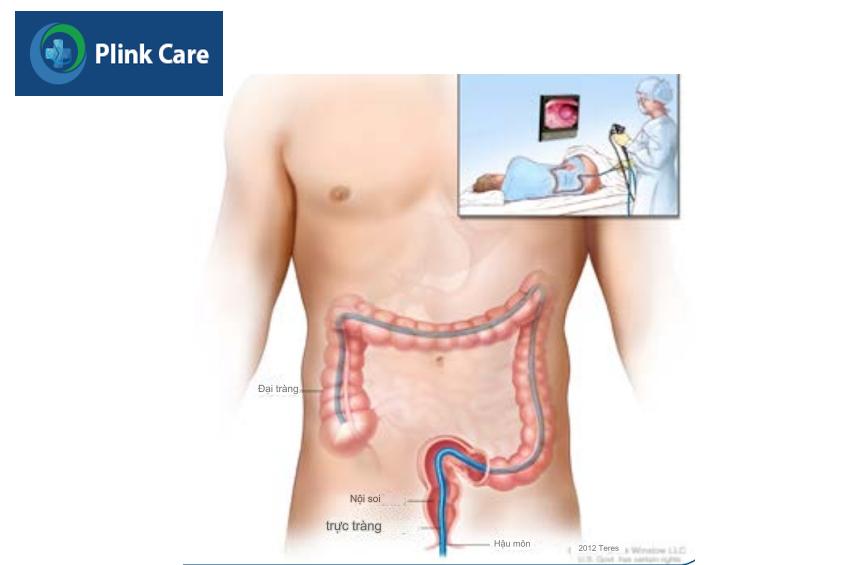 phương pháp nội soi tầm soát ung thư đại trực tràng