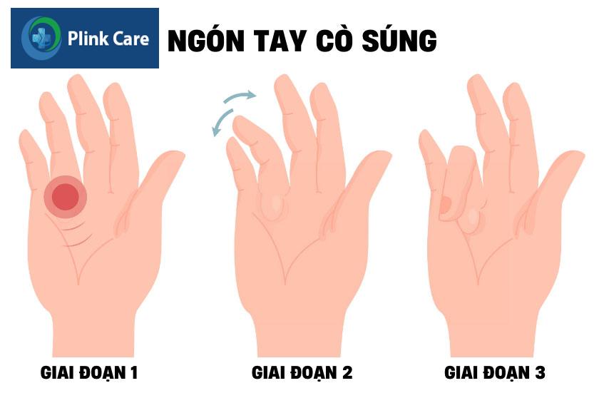 phương pháp tác động lên gân gấp