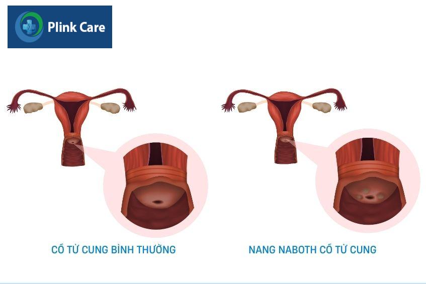 so sánh cổ tử cung bình thường và nang naboth