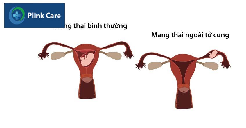 thai ngoài tử cung là một trong những nguyên nhân làm máu báo thai ra nhiều