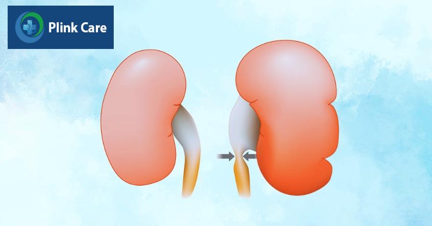 thận ứ nước giai đoạn 3