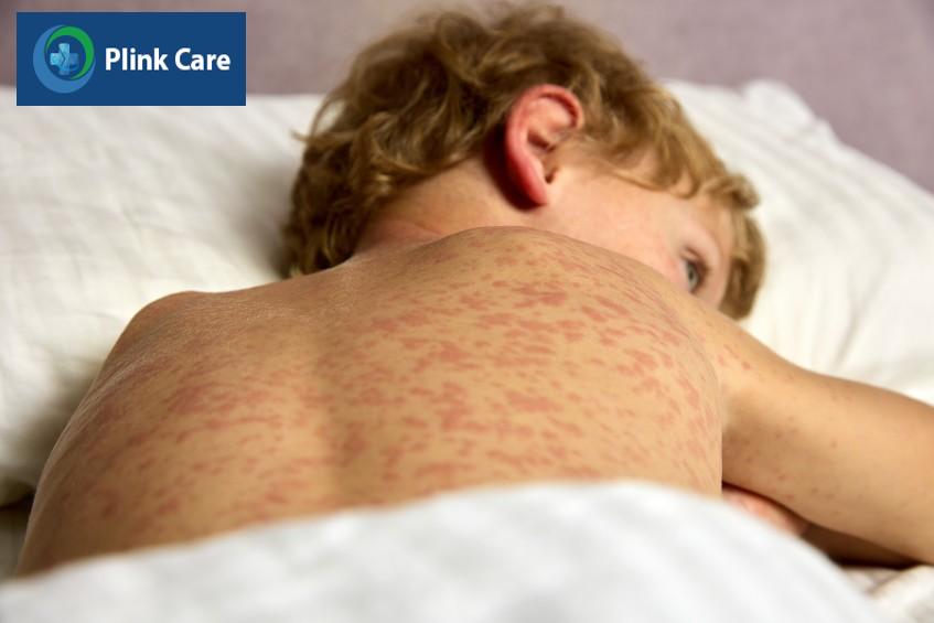 Trẻ bị sởi mệt mỏi, phát ban khắp cơ thể