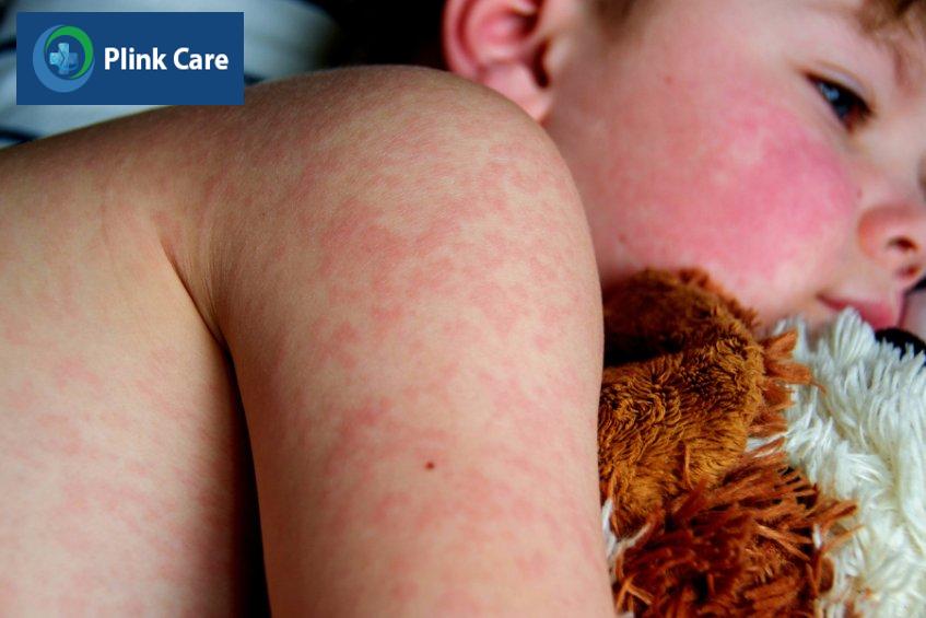 trẻ bị sởi phát ban đỏ toàn thân kèm sốt cao