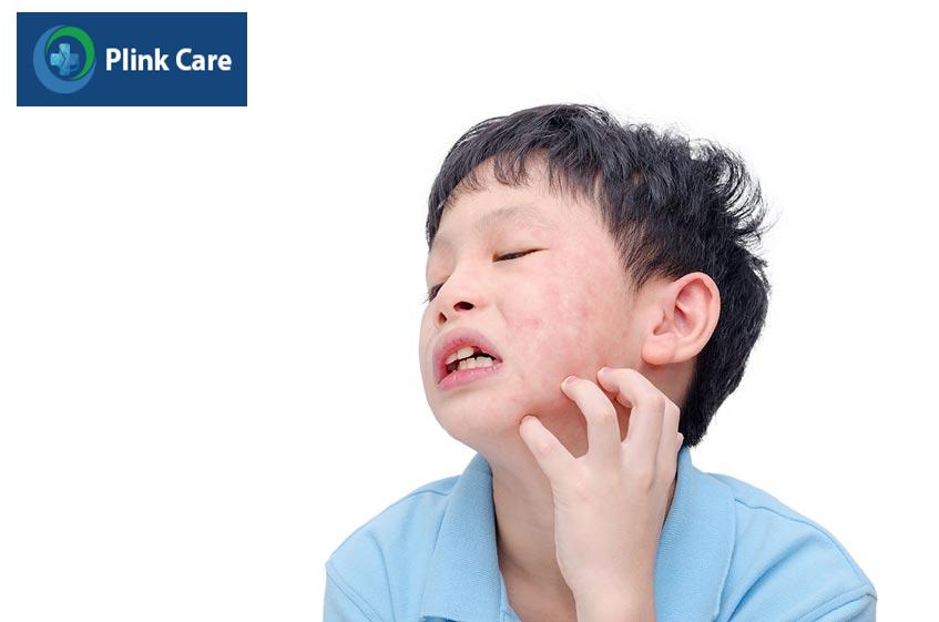 trẻ em thường bị mẩn ngứa do dị ứng nên thận trọng khi uống hapacol 250