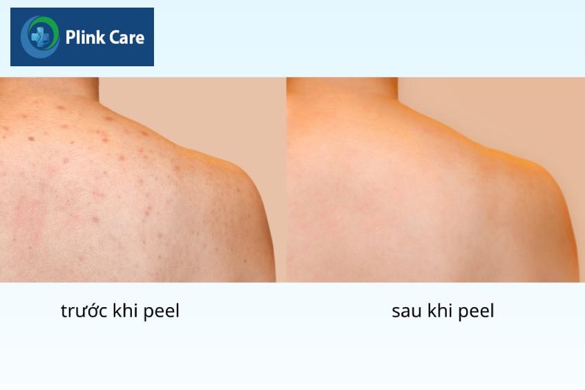 trước và sau khi peel da toàn thân