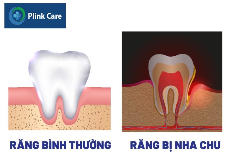 Triệu chứng của túi nha chu