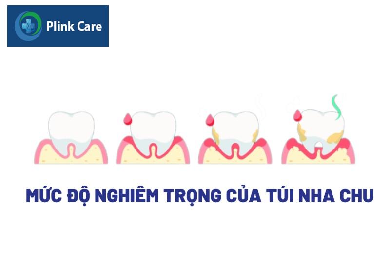 Kích thước và mức độ nghiêm trọng của túi nha chu