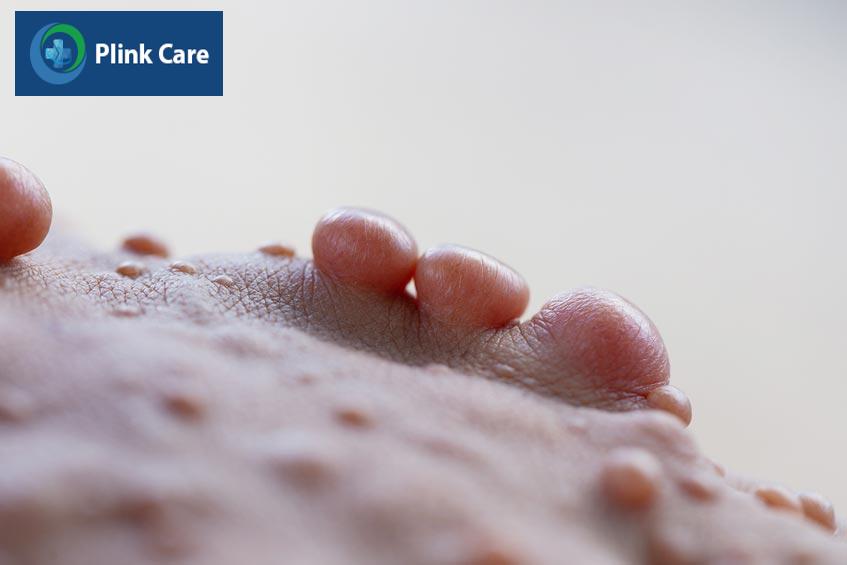 u xơ thần kinh thường có nhiều khối u tại nhiều vị trí khác nhau