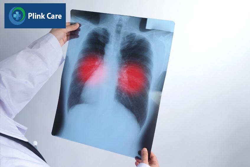 Ung thư phổi và xơ phổi là hai bệnh khác nhau