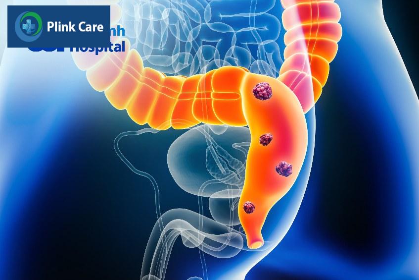 thực phẩm ung thư trực tràng nên ăn tốt cho người bệnh