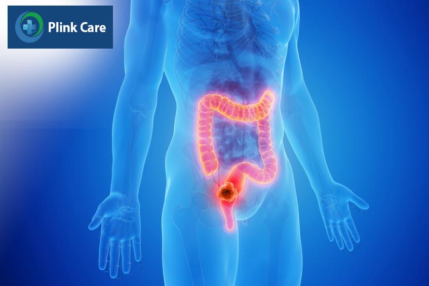 ung thư trực tràng ở giai đoạn 0 phương pháp phẫu thuật điều trị duy nhất