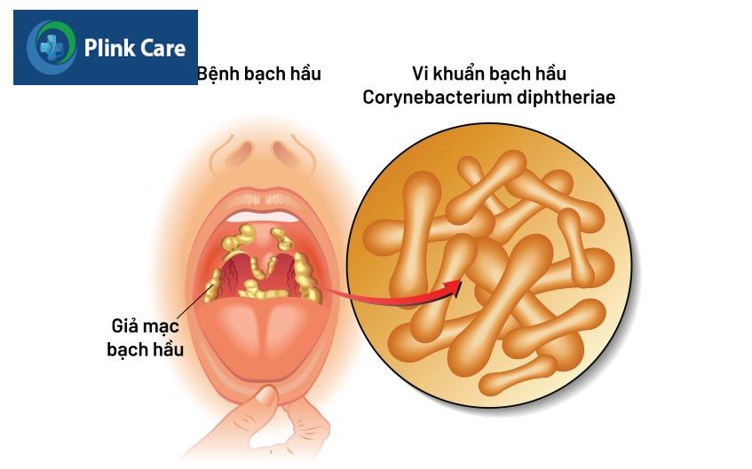 Vi khuẩn Corynebacterium diphtheriae xâm nhập