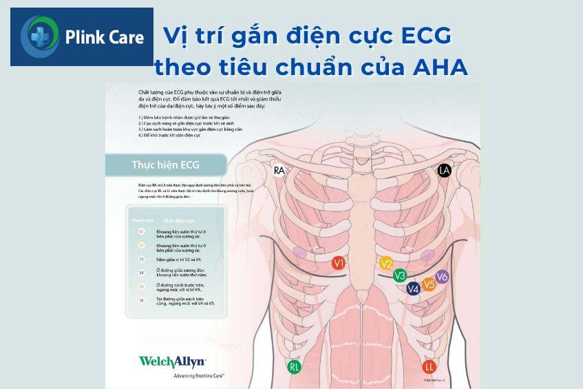 vị trí gắn điện cực ECG