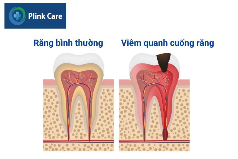 Viêm quanh cuống răng là gì?