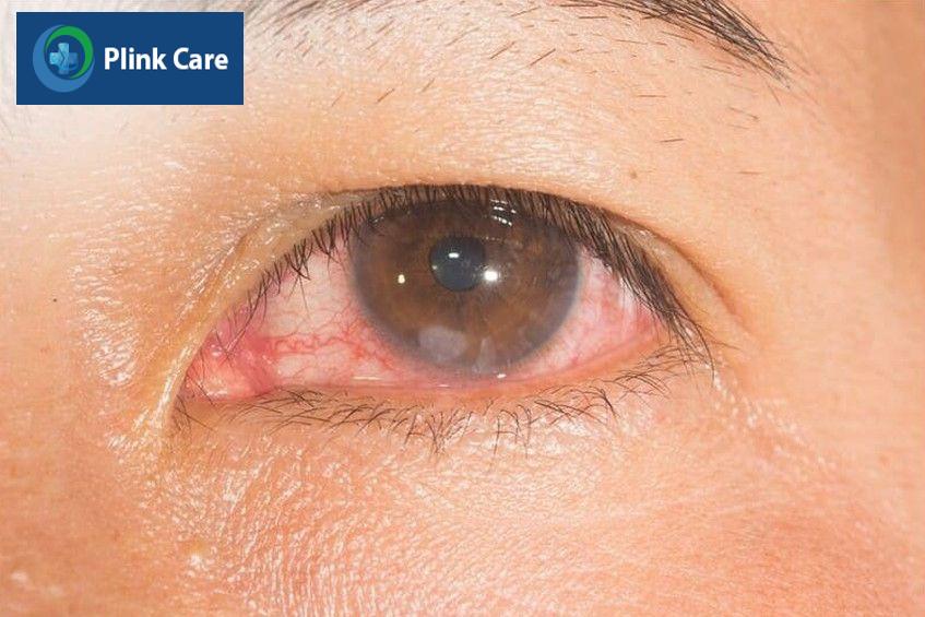 viêm kết mạc dị ứng do thuốc sẽ khỏi nhanh nếu được điều trị tích cực