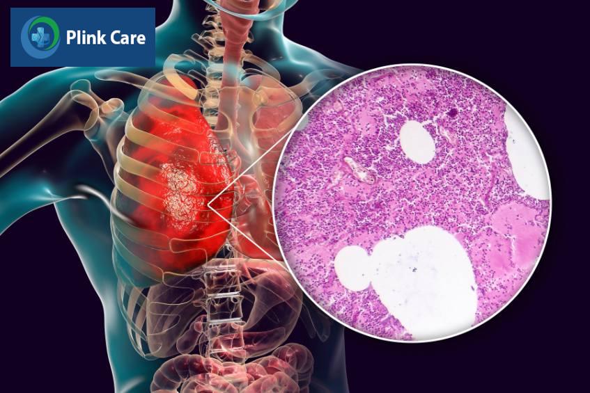 Viêm phổi thùy là tình trạng dịch tiết trong khoang phế nang