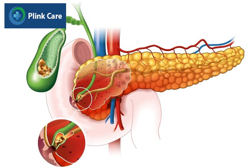 viêm tuyến tụy có nguy hiểm không