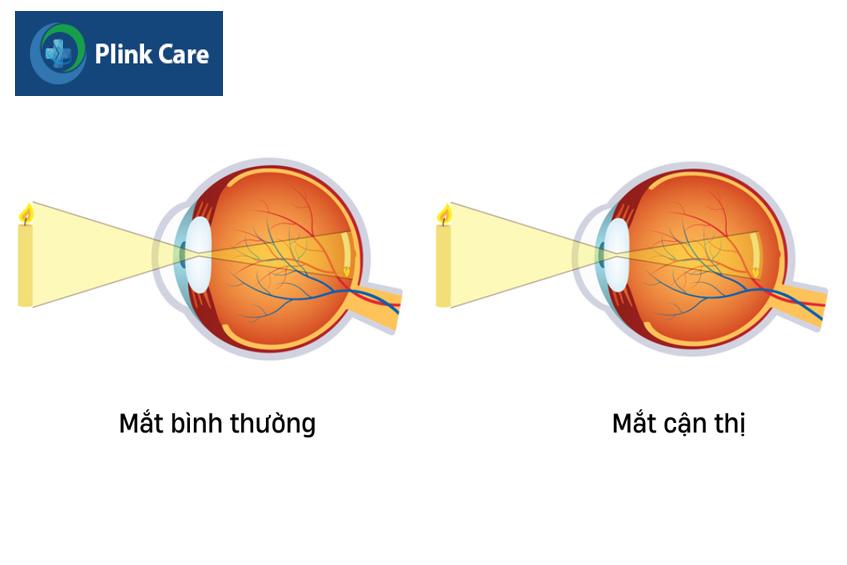 ảnh hội tụ phía trước võng mạc của người mắc cận thị