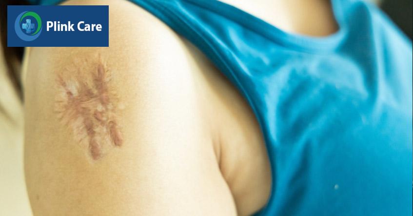 ảnh sẹo lồi ngứa