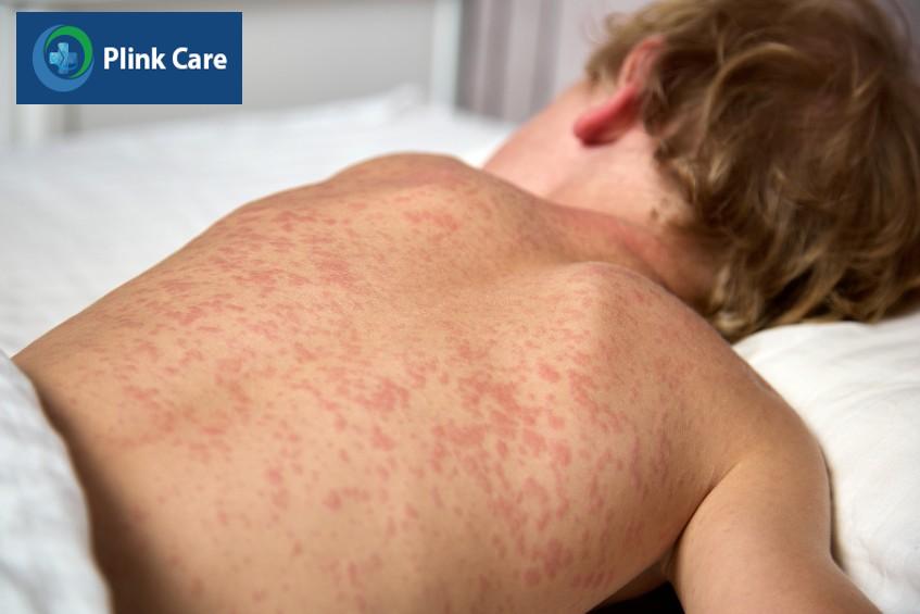 Ban đỏ nổi khắp người ở trẻ bị sởi