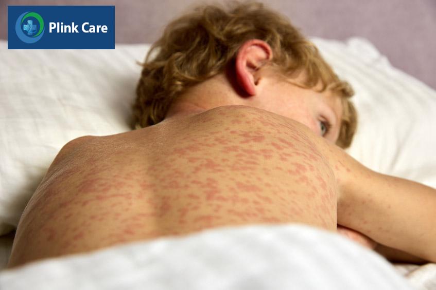 ban sởi lan rộng ra phần lưng của trẻ
