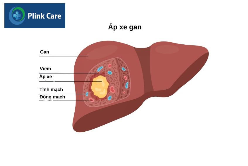 bệnh áp xe gan