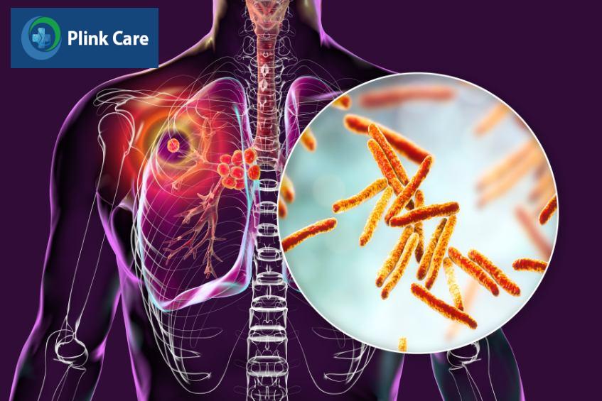 Bệnh lao phổi là một tình trạng nhiễm trùng phổi 