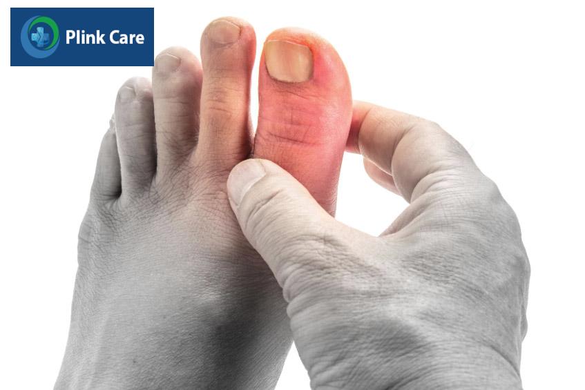 Bệnh nhân có biến chứng bị đau, sưng ở ngón chân cái (một dấu hiệu của bệnh gout)