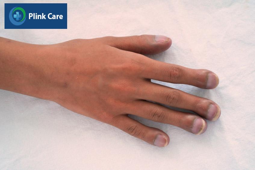 Bệnh nhân mắc hội chứng Eisenmenger với biểu hiện ngón tay dùi trống