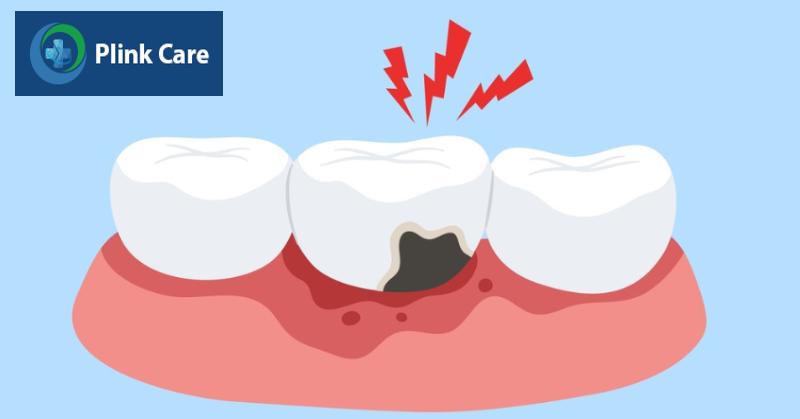 Các mức độ sâu răng thường gặp, Sâu răng độ 3, Sâu ngà sâu lan đến tuỷ