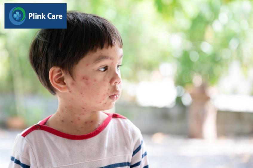 cần tìm hiểu về bệnh sởi và đặc điểm bệnh sởi dễ nhận biết