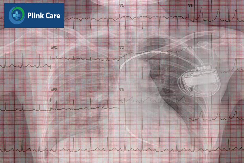Cấy ghép thiết bị tái đồng bộ cơ tim giúp buồng tim co bóp có tổ chức và hiệu quả hơn