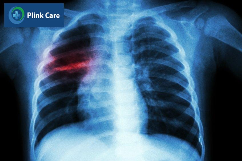 Chẩn đoán bệnh lao phổi trẻ em bằng X-quang