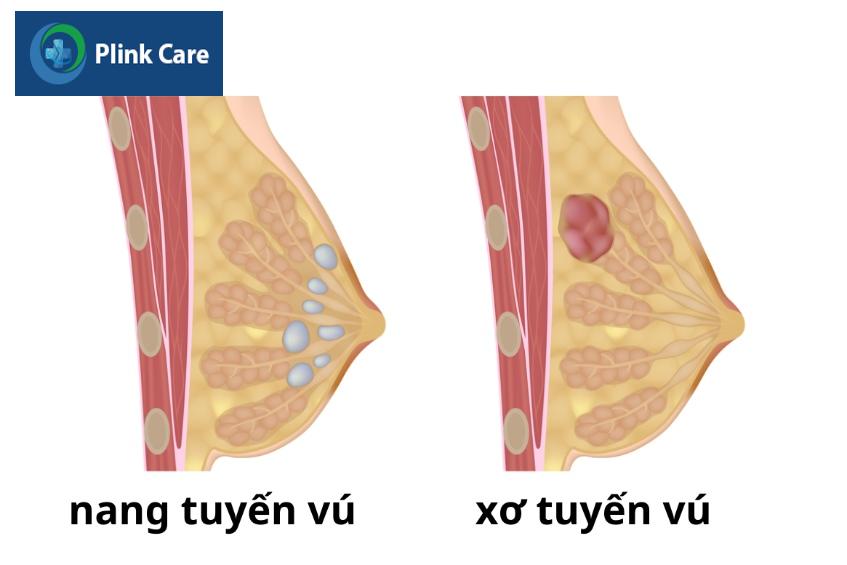 dạng khối u vú lành tính phổ biến
