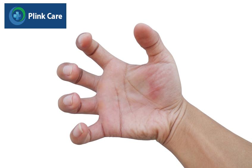 dấu hiệu động kinh cần sơ cứu đúng cách