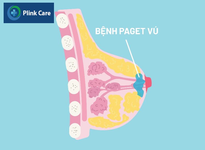 đầu ti bị đóng vảy