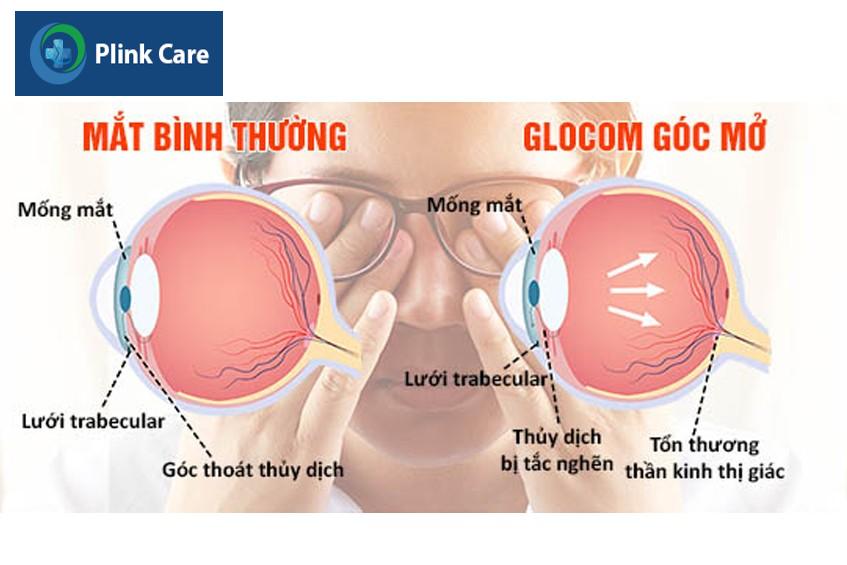 glocom góc mở và glocom mắt thường
