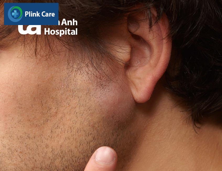hạch bạch huyết trước tai bị sưng