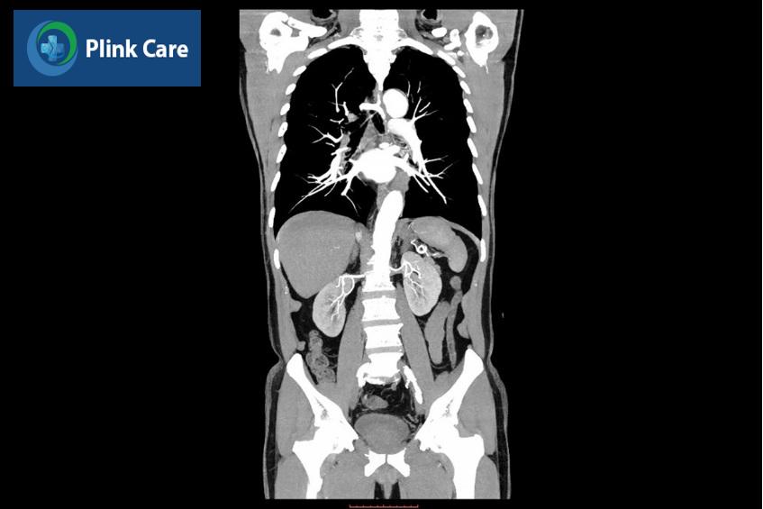 hình ảnh CT ngực bụng chậu