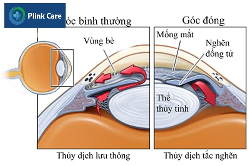 hình ảnh glocom góc đóng