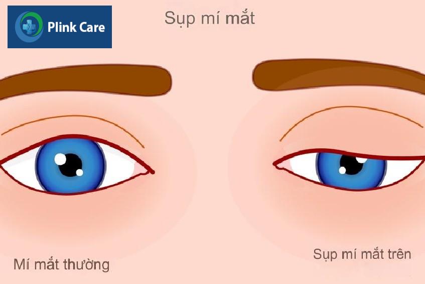 hình ảnh mắt sụp mí sau khi ngủ dậy