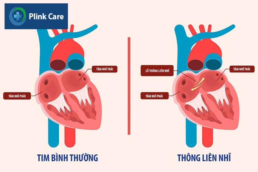 Hình ảnh minh họa tim bình thường (bên trái) và tim có dị tật thông liên thất (bên phải)